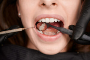imagem macro de um sorriso, deixando em evidência os dentes do fundo, fazendo referência ao siso.